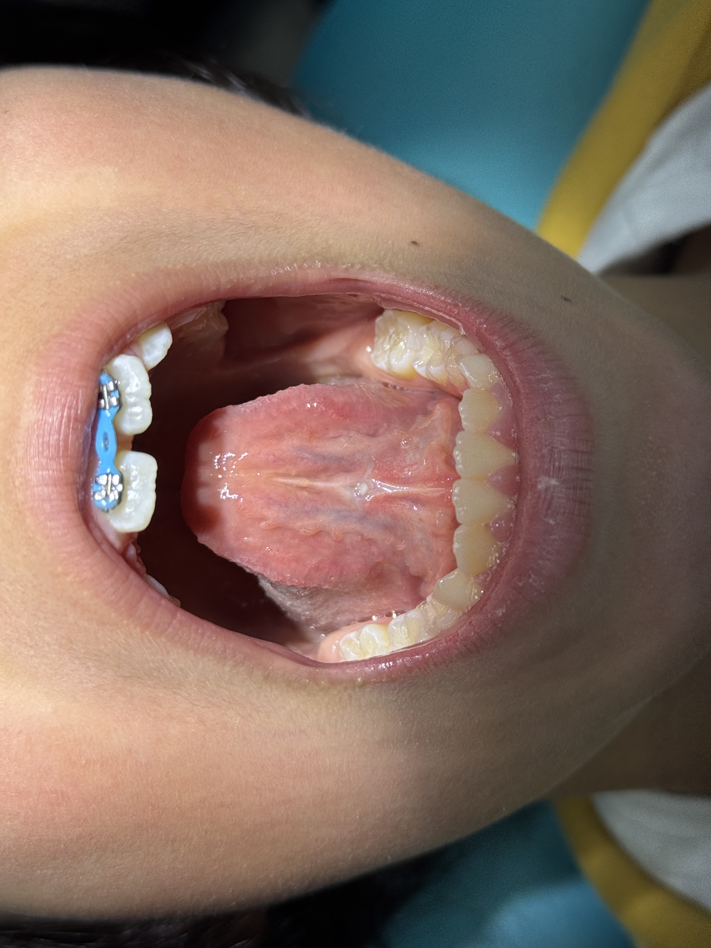 Antes — frenectomía